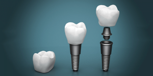 Implants