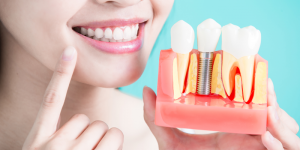Lady smiling holding Dental Implant Sample