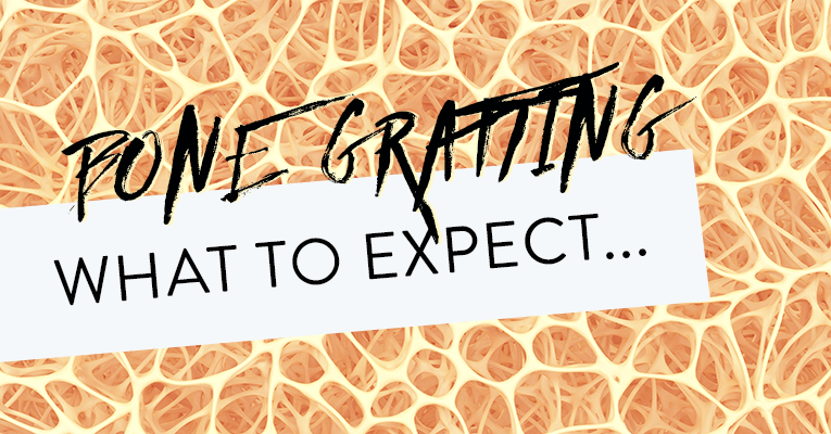 bone grafting-what to expect